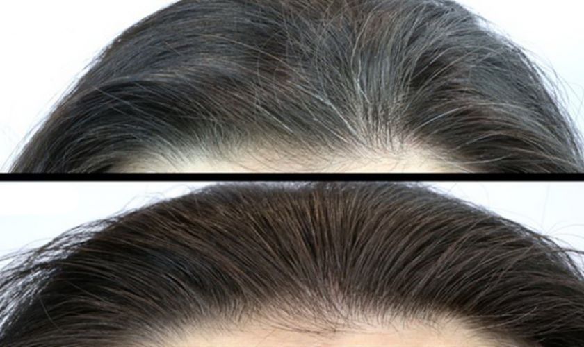 Մազերի սպիտակության առաջացման պատճառները և դրա դեմ պայքարի միջոցները