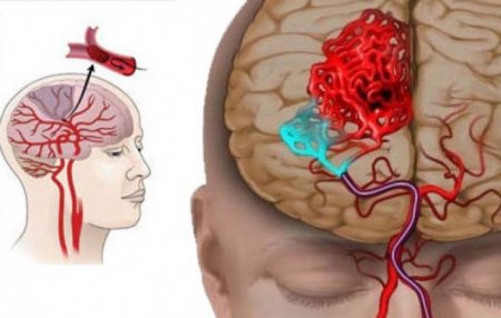 Տնական միջոց՝ գլխուղեղի արյան շրջանառությունը բարելավելու համար