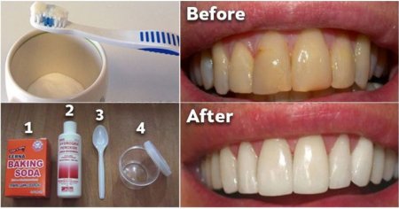 Ինչպես ազատվել ատամնափառից և սպիտակեցնել ատամներն առանց թանկարժեք պրոցեդուրաների