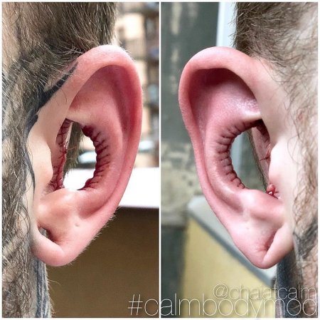 Մոդիֆիկացիայի վերջին ճիչը.տղամարդը վիրաբույժին խնդրել է հեռացնել ականջների մի մասը