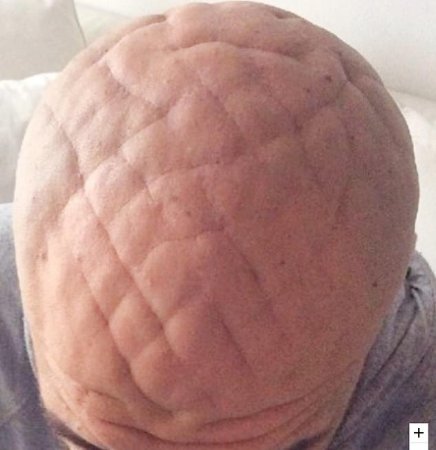 37-ամյա իտալացու գլուխը ձեւախեղվել է օրգանիզմում աճի հորմոնի ավելցուկի պատճառով